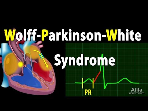 Wolff-Parkinson-White Syndrome Pathophysiology, Pre-Excitation and AVRT, Animation