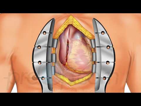 कोरोनरी धमनी बाईपास ग्राफ्ट (सीएबीजी) ऑफ-पंप प्रीओप® रोगी शिक्षा