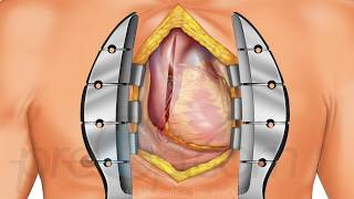 Coronary Artery Bypass Graft Cabg Off-Pump Preop Patient Education