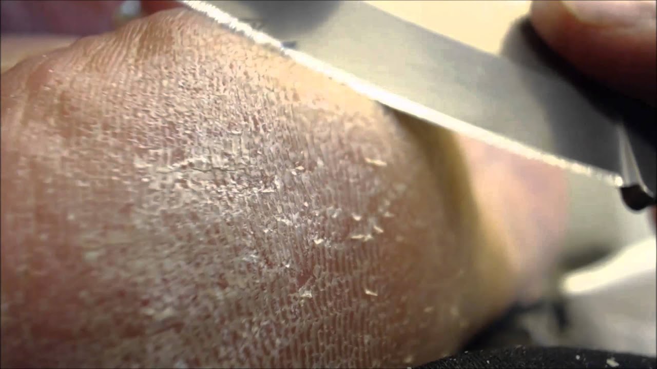 Heel Psoriasis or Just Plain Dry? YouTube
