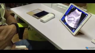 Blue imaging, ultrasound probe ipad, wireless probe demo