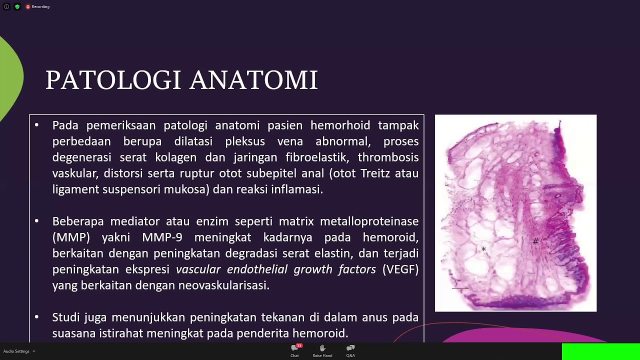 Patofisiologi Hemoroid