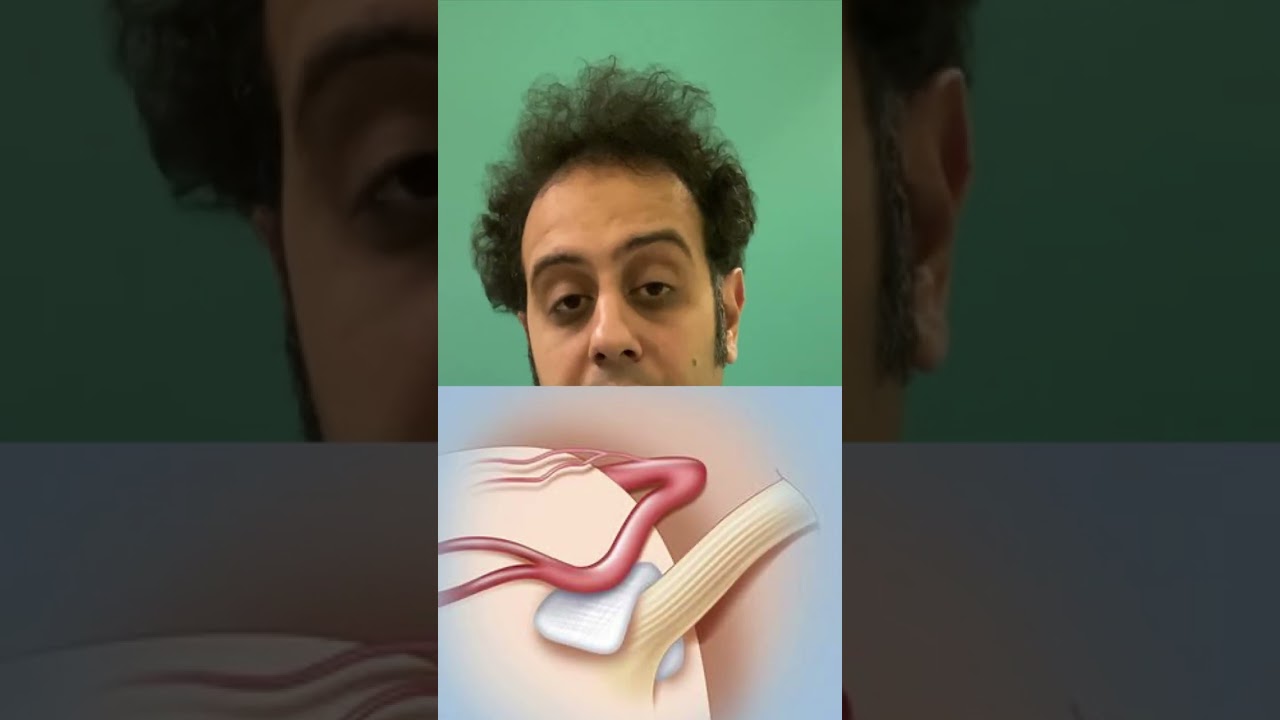 طنين الاذن بسبب التفاف الشريان المخي حول العصب السمعي