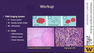 Soft Tissue Sarcoma  Safe Evaluation and Risk Stratified Approach to Management