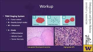 Soft Tissue Sarcoma  Safe Evaluation and Risk Stratified Approach to Management screenshot 5