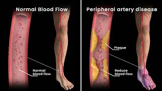 Why Do My Feet And Ankles Get So Swollen? Peripheral Artery Disease Explained