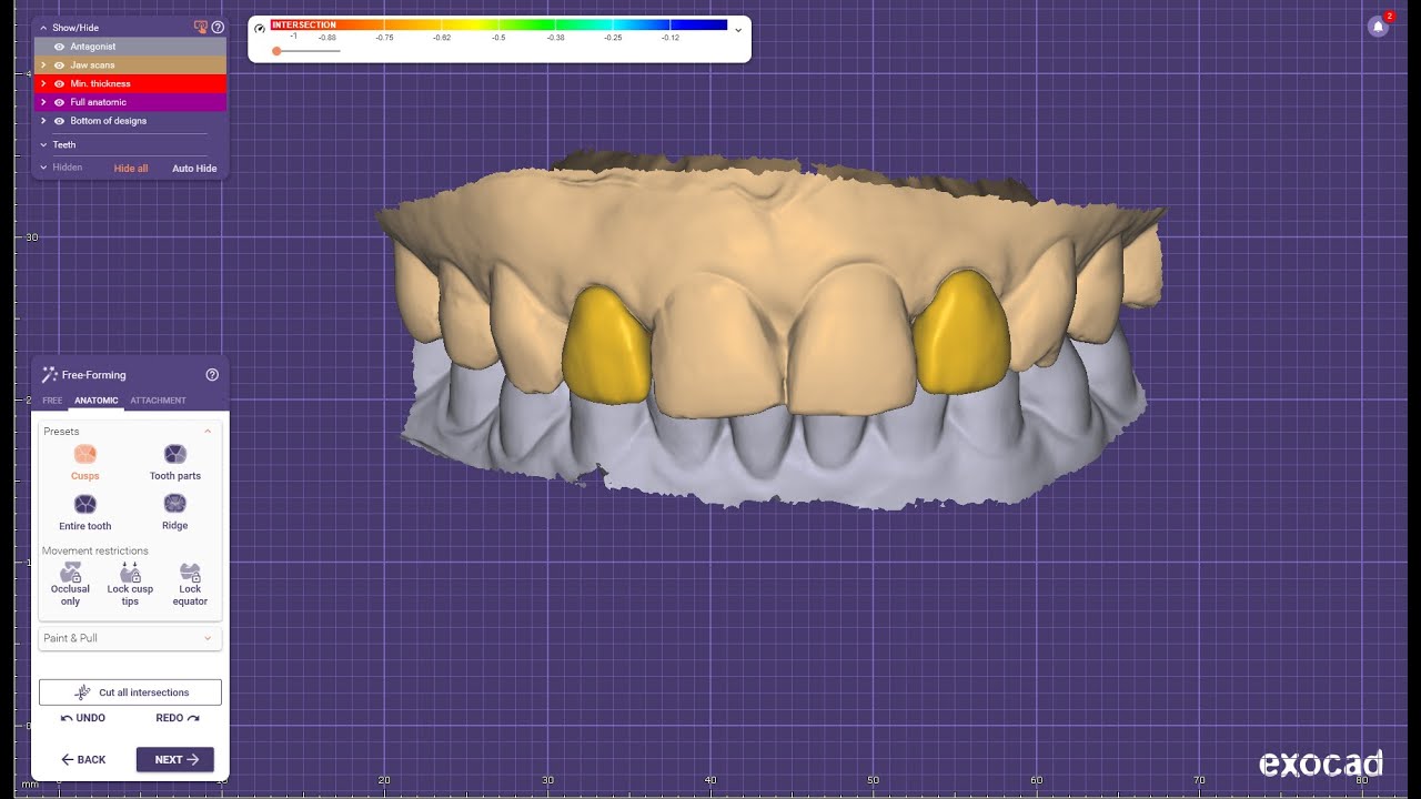 Tooth preparation designing in Exocad for upper anterior - YouTube