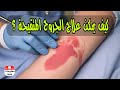 كيف يمكن علاج الجروح المتقيحة ؟How can suppurating wounds be treated؟