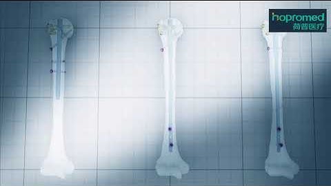 Humerus, Proximal - 3-Part Fracture - Reconstruction Using the MultiLoc Proximal Humeral Nail