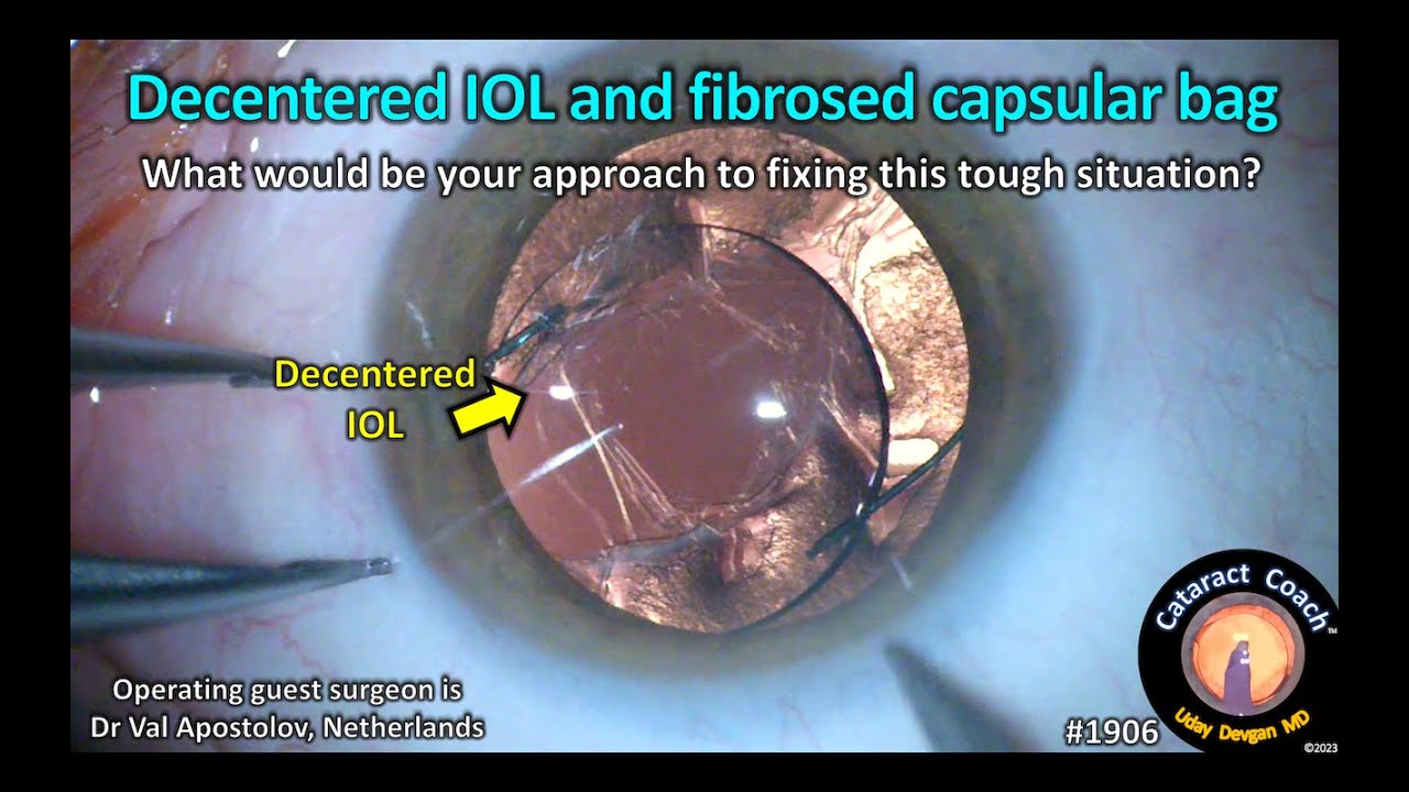 Torn Anterior Capsule - Cataract & Refractive Surgery Today