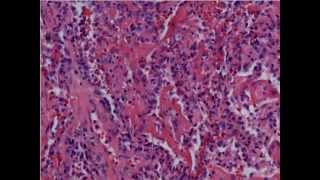 Acute Lung Injury