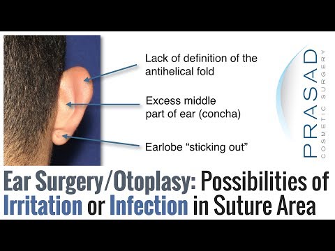 Video: Otoplasty - Indications, Preparation For The Procedure, Consequences, Reviews