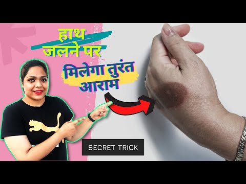 HOW TO TREAT KITCHEN BURNS NATURALLY | HOME REMEDIES TO TREAT BURNS NATURALLY | BURN TREATMENT