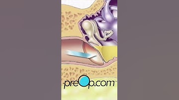 PreOp® Myringotomy – Insertion Of Tube | Must-Know Patient Info 👂 #Shorts