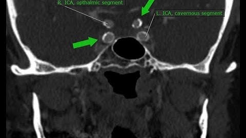 Detecting signs of Type II Diabetes on CBCT X-ray Images