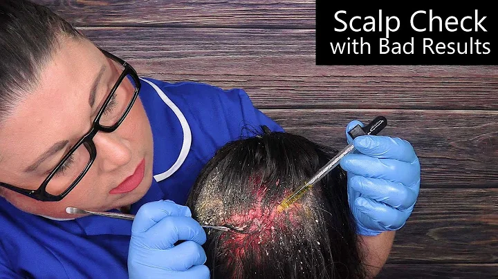 ASMR Scalp Check with Bad Results (Dandruff Removal, Scalp Treatment, Whispering) Medical Roleplay