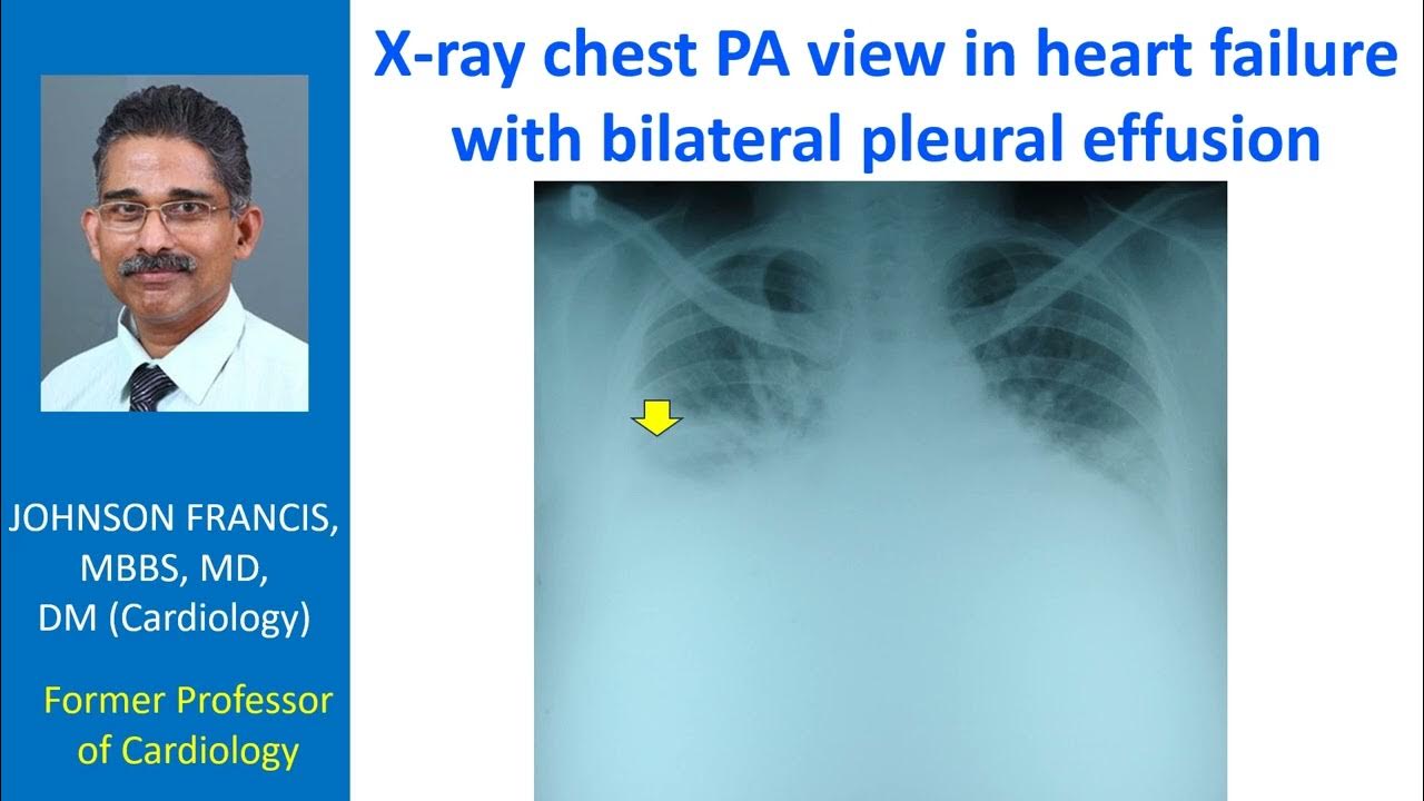 Xray chest PA view in heart failure with bilateral pleural effusion