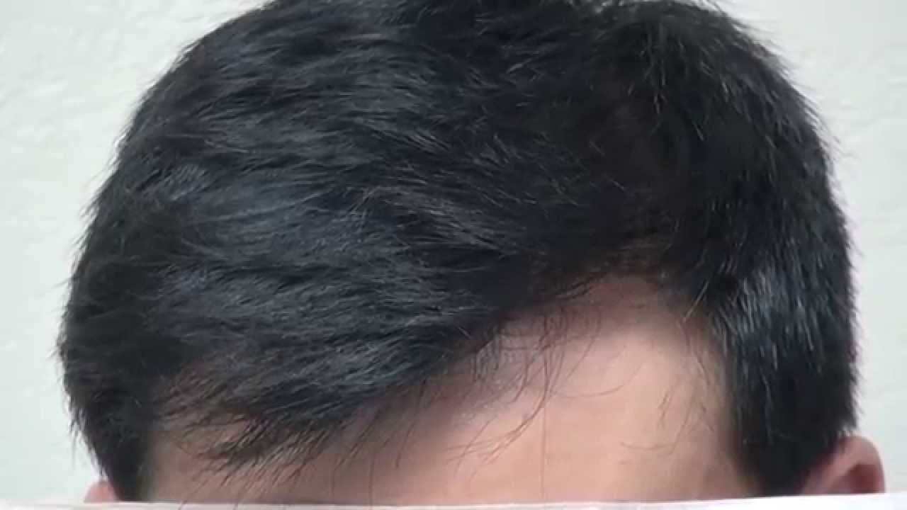 Asian Male Receding Hairline Transplant Restoration Dr Diep Www