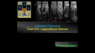 Ultrasound Case 315 - Appendiceal Abscess