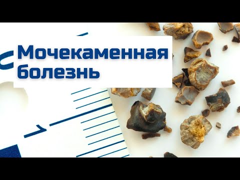 Мочекаменная болезнь | Причины, симптомы, диагностика и лечение