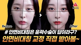[안면비대칭] 비용, 위험부담으로 못하는 윤곽, 양악수술 말고❗ 피부과 시술로만 교정 성공 찐 후기❗