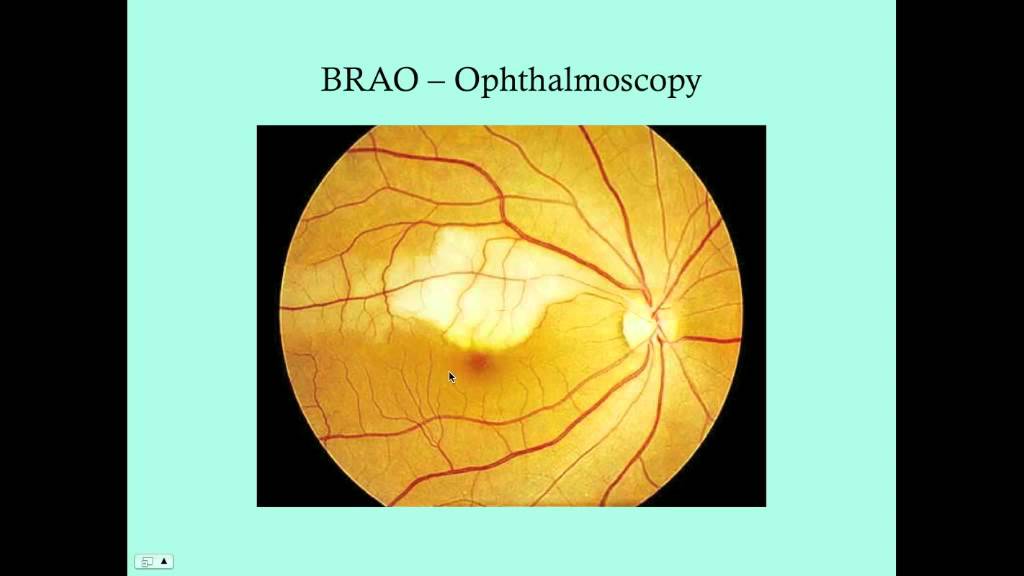 Retinal Vascular Disorders - CRASH! Medical Review Series