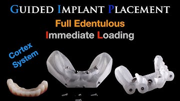 Guided Surgery, Full edentulous with immediate loading