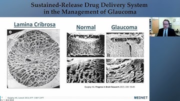 Sustained-Release Drug Delivery System in the Management of Glaucoma