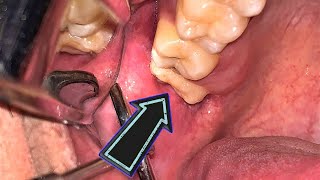 Maxillary Third Molar Extraction | Pencabutan Gigi Bungsu Atas | Dentist | Dokter Gigi Tri Putra