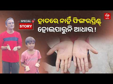 No palm lines: Skin disease acts as a barrier to Aadhaar, Sameer deprived of government benefits
