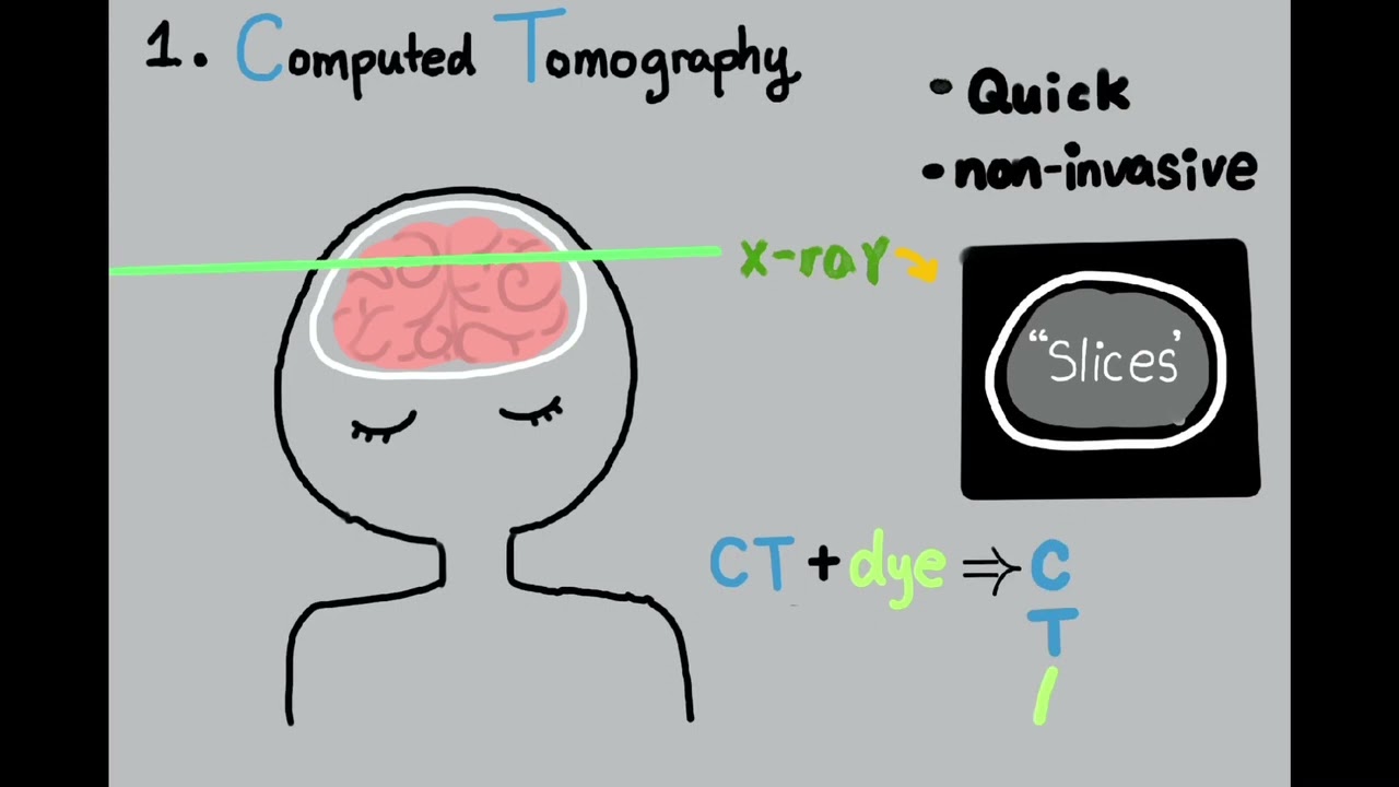 How Do We Find Brain Aneurysms?