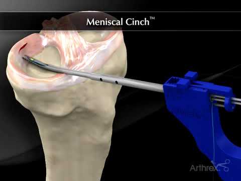 Meniscal Cinch