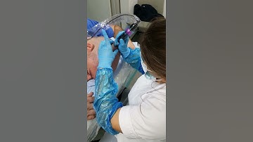 SMP Male Scalp Micropigmentation by El Truchan @ Scalp Micro Definition