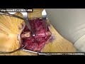 動画5　腰椎変性すべり症に対する腰椎後方椎体間固定術