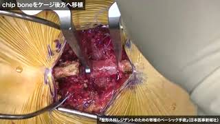 動画5　腰椎変性すべり症に対する腰椎後方椎体間固定術