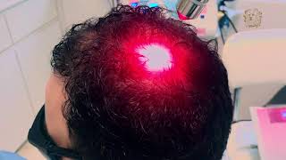 Capilares para tratamento laser quebrados a