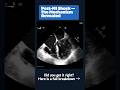 Post MI Shock — Ischaemic MR or Papillary Muscle Rupture?