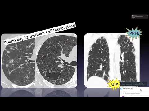 21.8) Polmone: le malattie infiltrative diffuse - Prof. Nicola Sverzellati