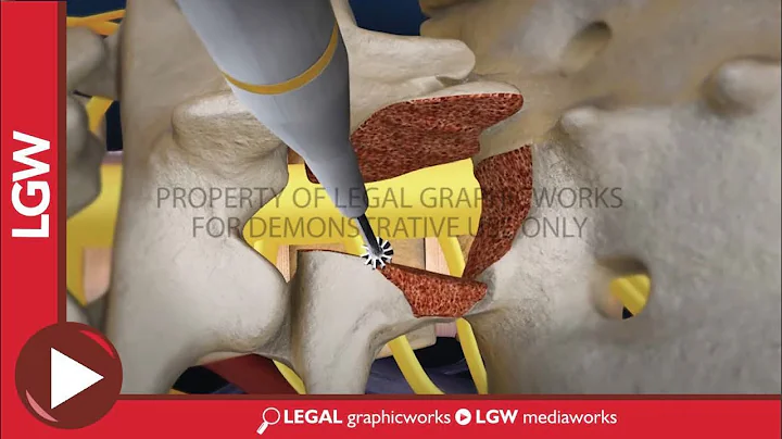 Lumbar Fusion of L5 - S1 transforaminal interbody ...