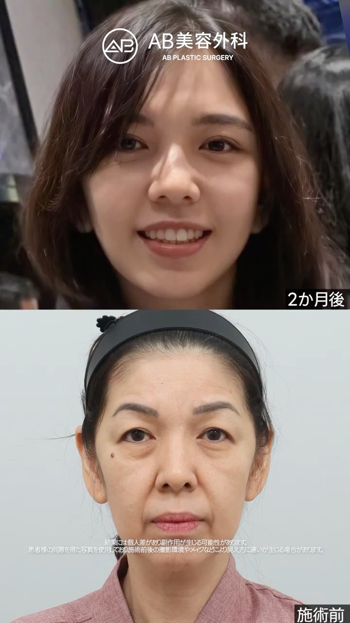 「本当に同じ人？」フルカスタムリフトで劇的変身を遂げた2か月後 #shorts