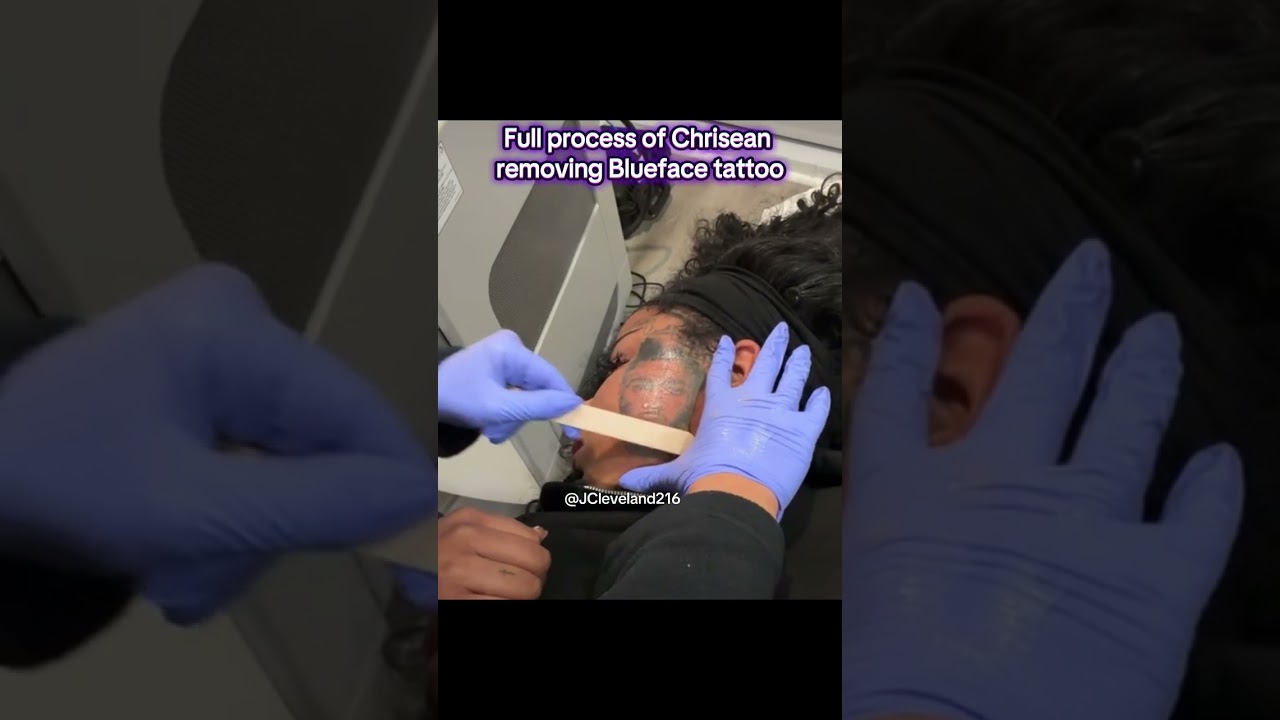 Chrisean gets Blueface tattoo removed from her face 12/16/25