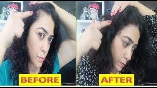 90 DAYS HAIR REGROWTH CHALLENGE / ये हैं वो इकलौती चीज जो गंजे सिर पर बाल उगा सकती है REGROWZ