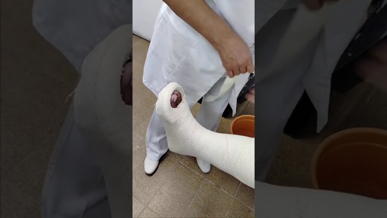 Segunda parte  da tala surgiu podalica ,para contusão, entorse ou fratura  .