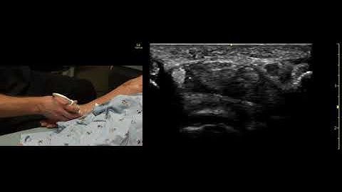 Identifying the Median Nerve in the Forearm for POCUS Guided Regional Anesthesia