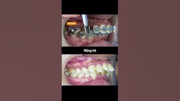 Cận cảnh quá trình răng chen chúc nặng thay đổi