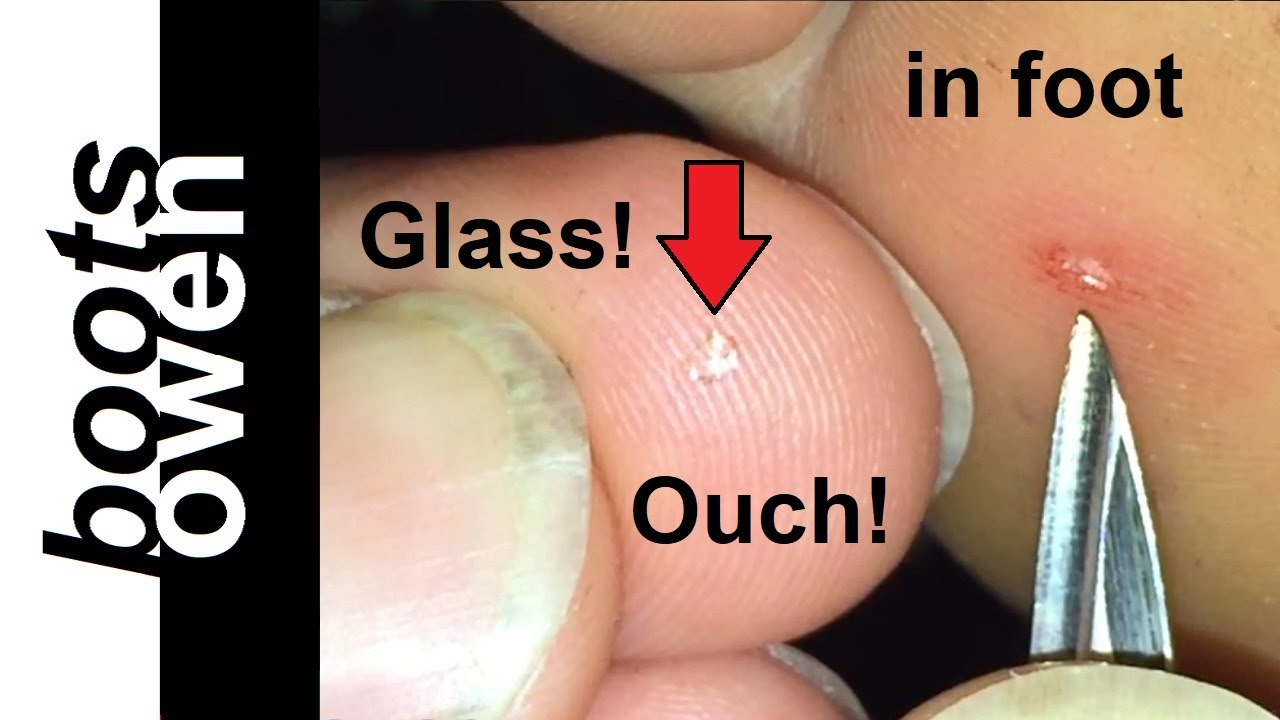 How To Remove A Tiny Shard Of Glass Embedded In Foot: Try This One Simple Easy Trick