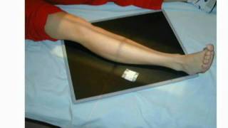Tib Fib AP.wmv
