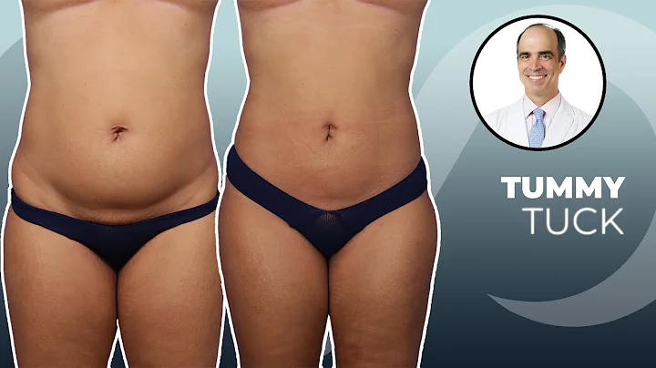 Female Body Sculpting | Before & After | Dr. David...