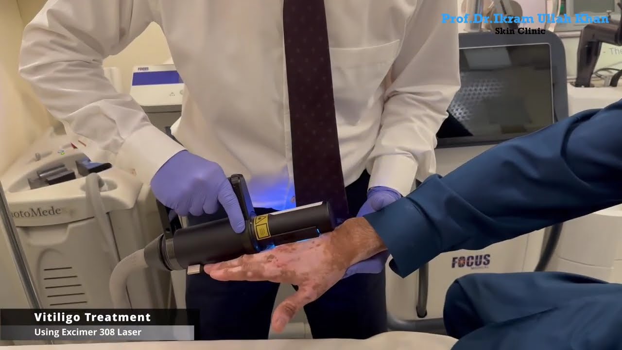 Excimer 308 laser treatment for Vitiligo Patches by Prof.Dr.Ikram Ullah Khan