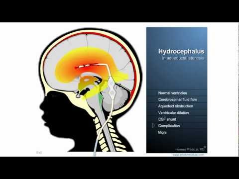 Video: Hyperdynamiske CSF-bevægelsesprofiler Fundet I Idiopatisk Normalt Tryk Hydrocephalus Og Alzheimers Sygdom Vurderet Af Væskemekanik Afledt Af Magnetisk Resonansbilleder